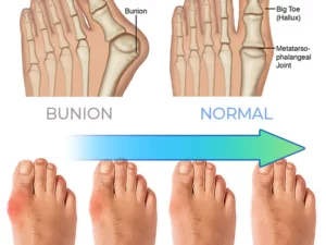ERGOic™ Anti-Bunions Health Sock