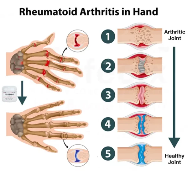 Hufen Therapi Ar y Cyd ac Esgyrn Fivfivgo™ FlexiCure