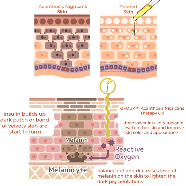 GFOUK™ Acanthosis Nigricans থেরাপি-Öl