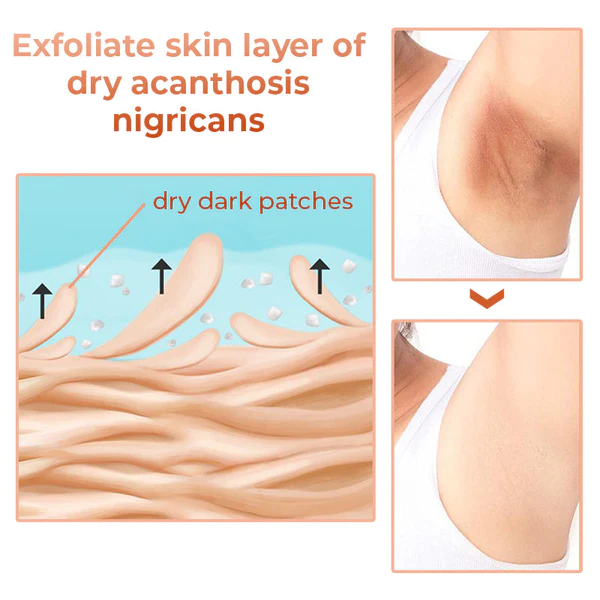 GFOUK ™ Acanthosis Nigricans Therapie-Öl