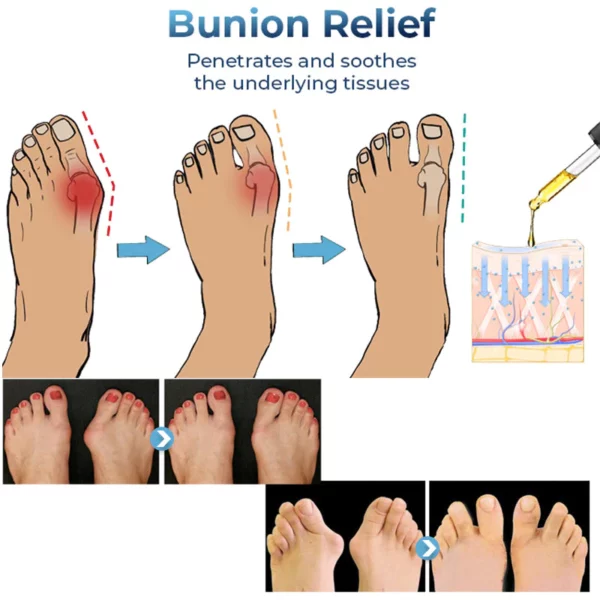 Minyak Relief Bunion Jerman GFOUK™