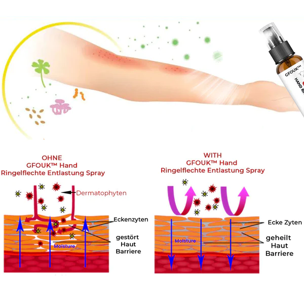 GFOUK™ Hånd Ringelflechte Entlastung Spray