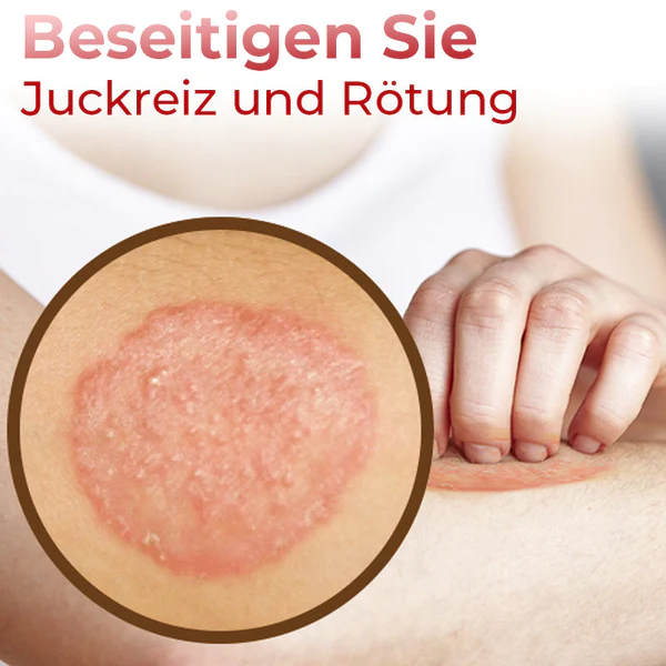 GFOUK™ Linderungsspray gegen Ringelflechte für die Hände