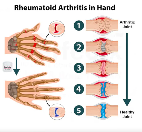 GFOUK™ OsteoRevive एडवांस्ड सपोर्ट क्रीम