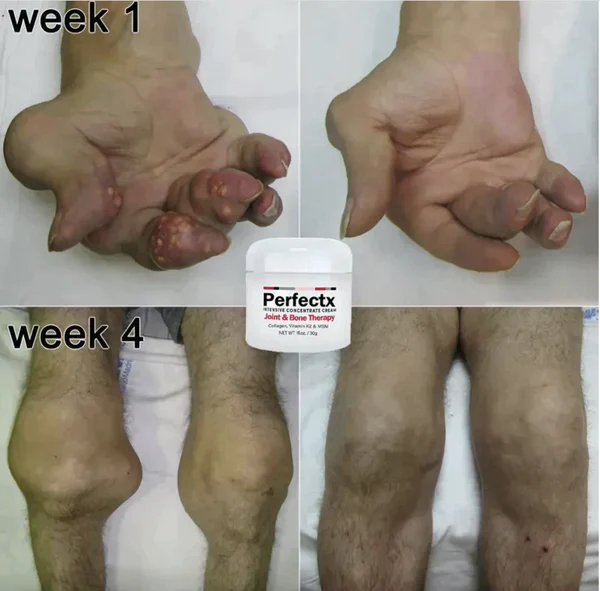 Crema de terapia ósea e articular GFOUK™ Perfectx