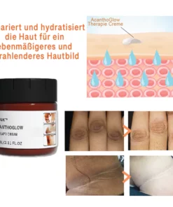GFOUK™ AcanthoGlow Therapie Creme