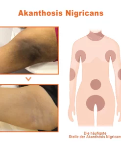 GFOUK™ AcanthoGlow Therapie Creme