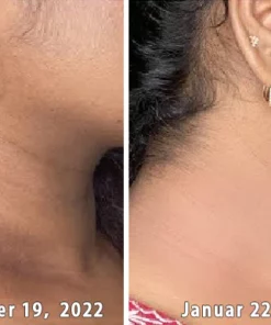 GFOUK™ AcanthoGlow Therapie Creme