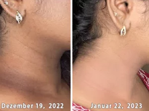 GFOUK™ AcanthoGlow Therapie Creme