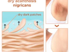 GFOUK™ Acanthosis Nigricans Relief Oil