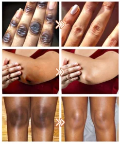 GFOUK™ Acanthosis Nigricans Relief Oil