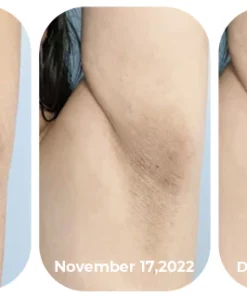 GFOUK™ Acanthosis Nigricans Relief Oil