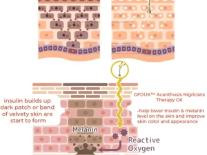 GFOUK™ Acanthosis Nigricans Therapie-Öl