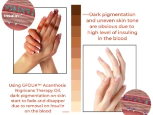 GFOUK™ Acanthosis Nigricans Therapie-Öl