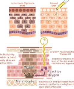 GFOUK™ Acanthosis Nigricans Therapy Oil