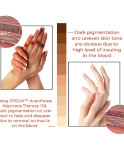 GFOUK™ Acanthosis Nigricans Therapy Oil