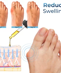 GFOUK™ German Bunion Relief Oil