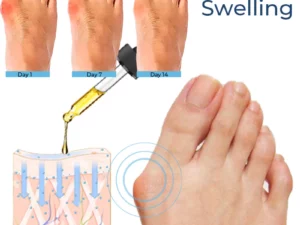 GFOUK™ German Bunion Relief Oil