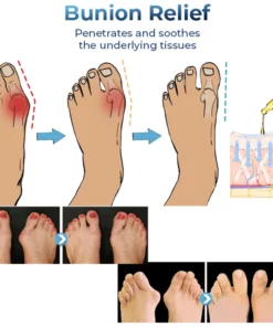 GFOUK™ German Bunion Relief Oil