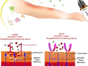 GFOUK™ Hand Ringworm Relief Spray