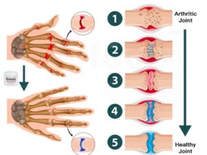 GFOUK™ Perfectx Joint And Bone Therapy Cream