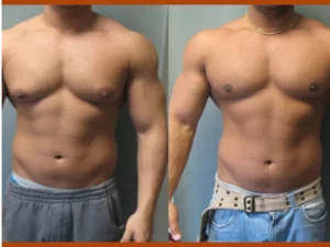 Gynecomastia Chest Tightening Spray