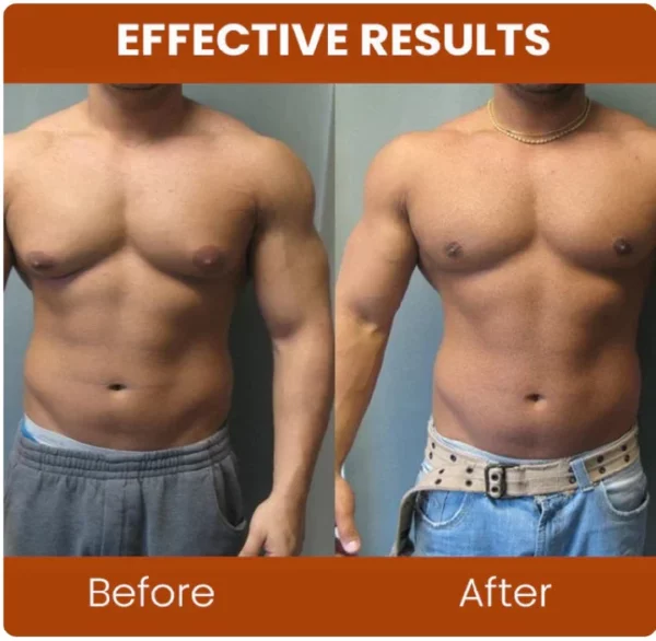 Gynecomastia छाती कस्ने स्प्रे