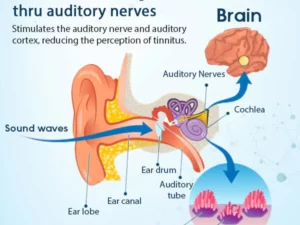 HearEase™ Tinnitus Linderung Behandlung Ohrpflaster