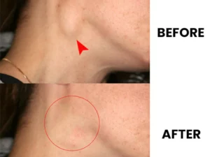Lymph Nodes Herbal Detox Patch