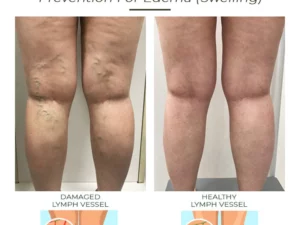 LymphaticDrainage DetoxGinger FootBath