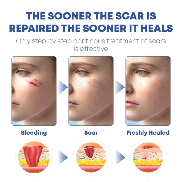 MEDVMA Non-Surgical ScarRemoval SiliconTape