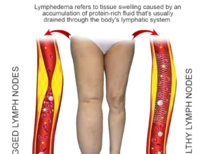 MediGinger AntiSwelling LympUnclog Ointment