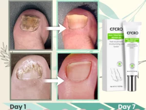 Nail Repair Treatment Gel