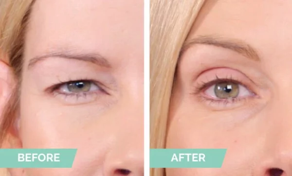 One® Natural Invisible Eyelid