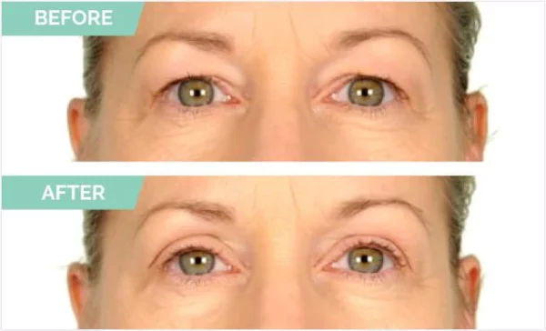 One® Natural Invisible Eyelid