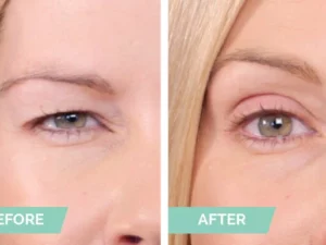 One® Natural Invisible Eyelid