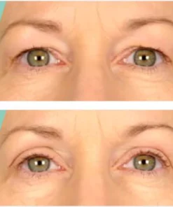 One® Natural Invisible Eyelid