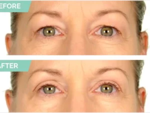 One® Natural Invisible Eyelid