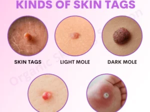 Organic SkinTag Solution