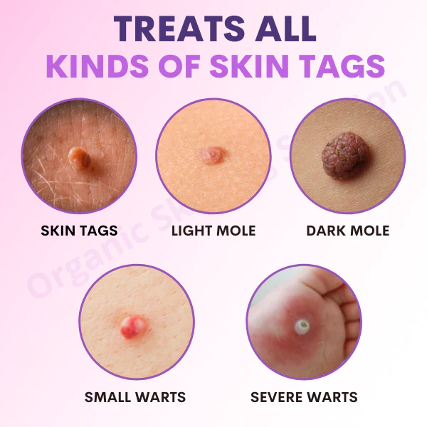 කාබනික SkinTag විසඳුම