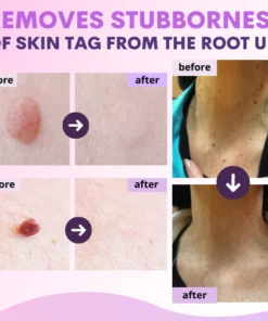 Organic SkinTag Solution