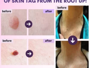 Organic SkinTag Solution
