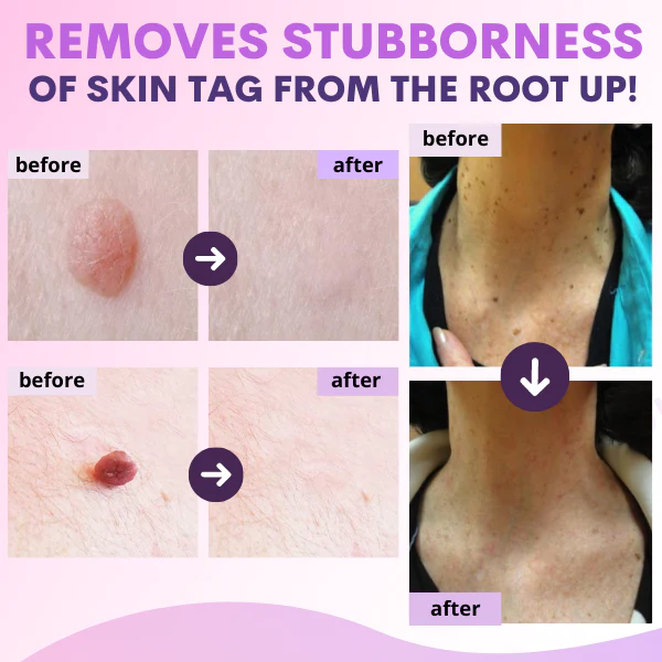 Organic SkinTag Solution