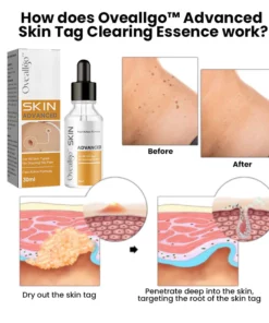 Alternative view of Oveallgo™ Advanced Skin Tag Clearing Essence