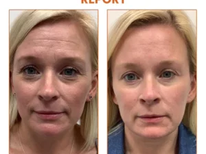 Oveallgo™ Byeol Korea Infusing Collagen Anti-aging Mask