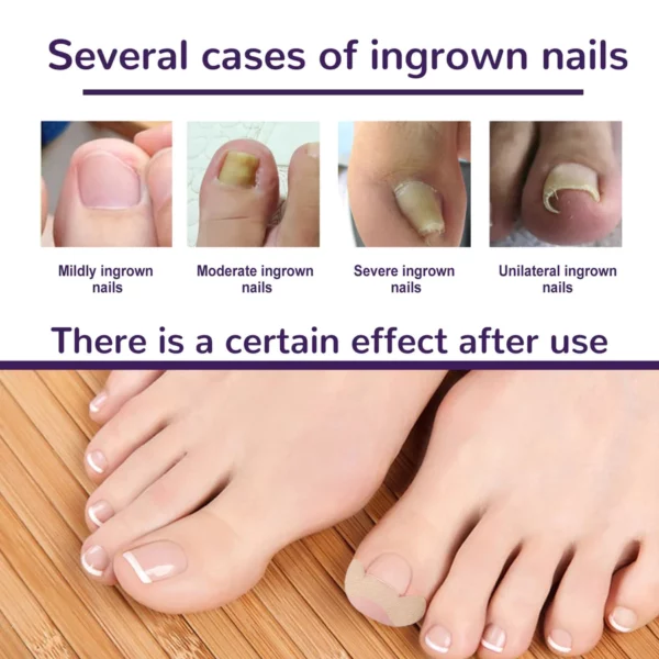 PARONYCHIA REPAIR NAIL التصحيح المرن التصحيحي