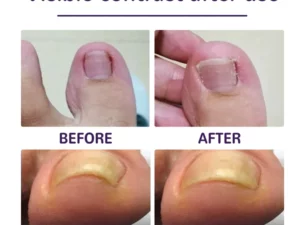 PARONYCHIA REPAIR NAIL ELASTIC CORRECTIVE PATCH