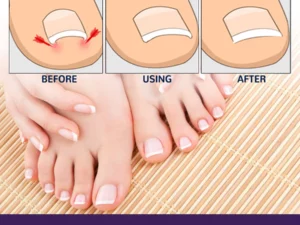 PARONYCHIA REPAIR NAIL ELASTIC CORRECTIVE PATCH