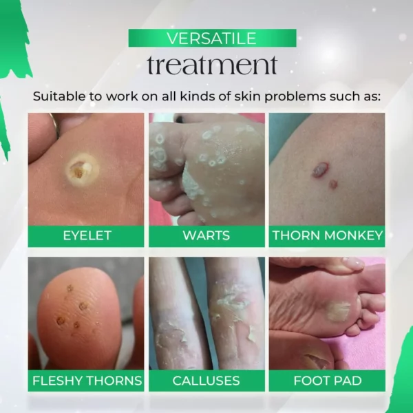 PodiaCorn™ Crema para eliminar los callos en los pies