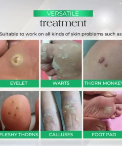 PodiaCorn™ Foot Corn Removal Cream